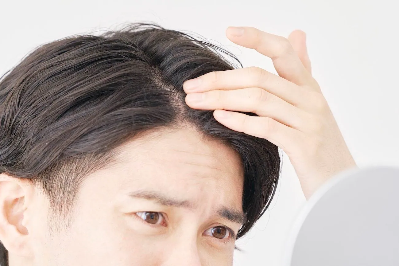 A young man worried about balding while checking his hairline
