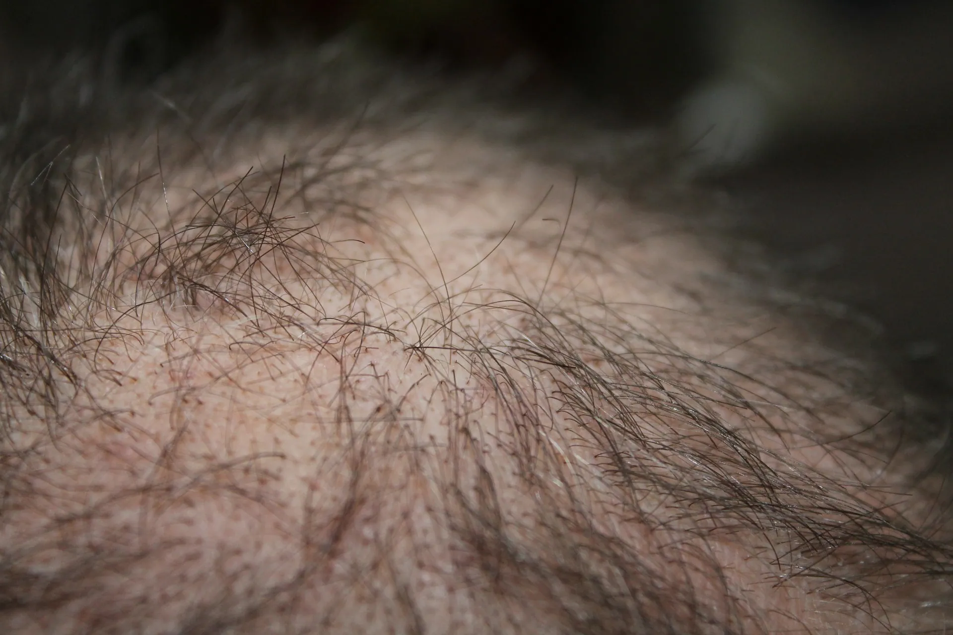 Closeup shot of a man's scalp with thinning hair